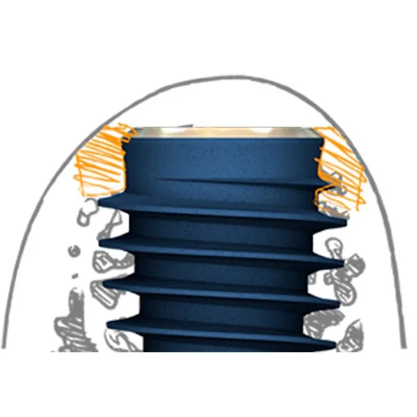 Схематичное изображение преимуществ имплантатов anyridge для одномоментной имплантации