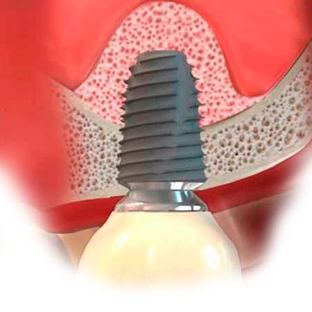 Схематичное изображение протезирования после закрытого синус-лифтинга
