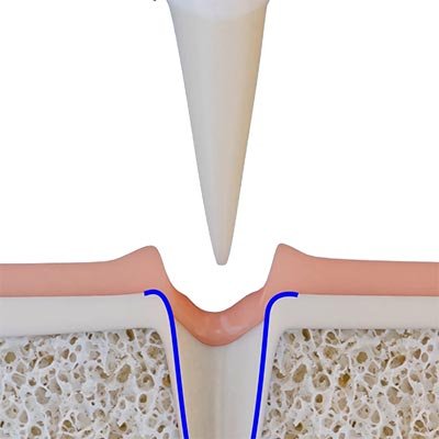 схематичное изображение атравматичного удаления зуба